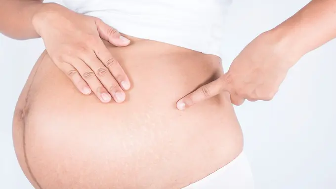 Ilustrasi strech mark pada ibu hamil