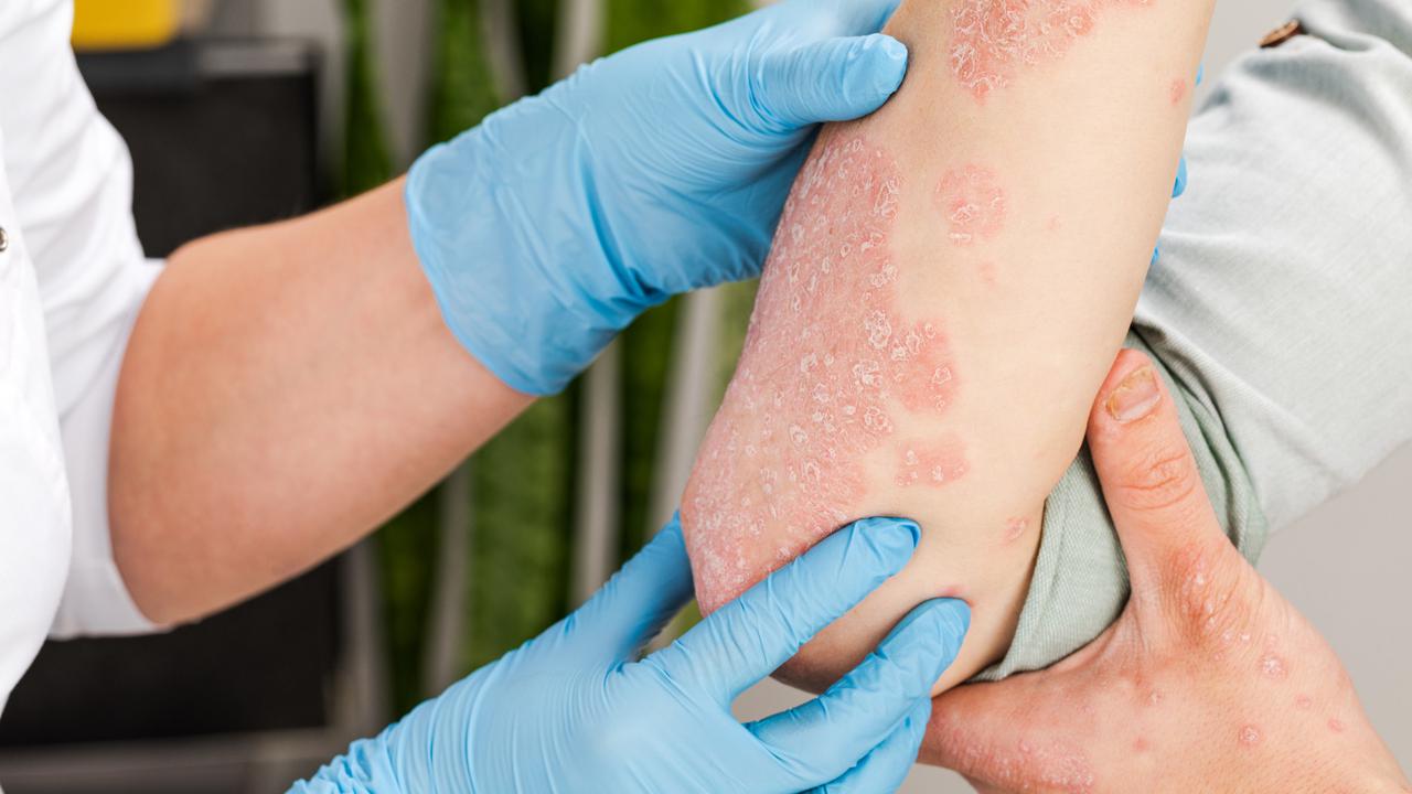 Psoriasis