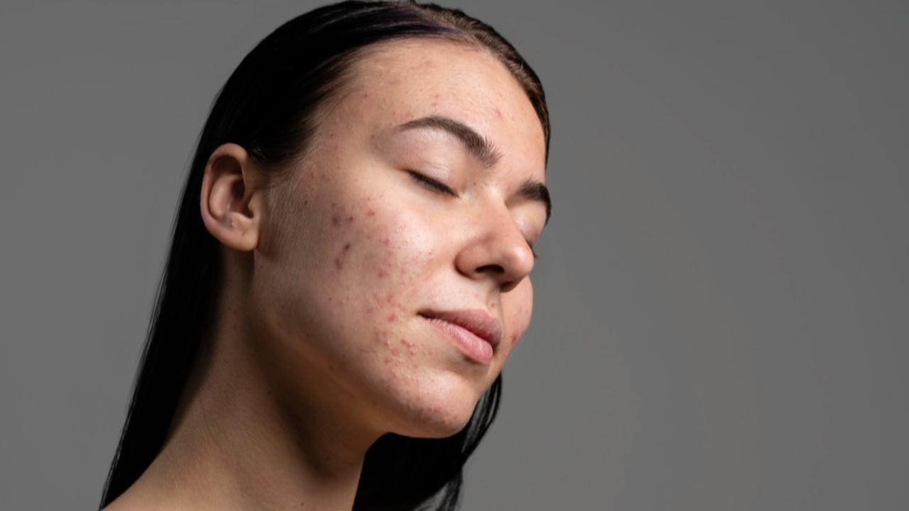Bukan Pakai Banyak Skincare, Ini Cara Cepat Mengatasi Jerawat Tanpa Iritasi dan Minimal Bahan Aktif