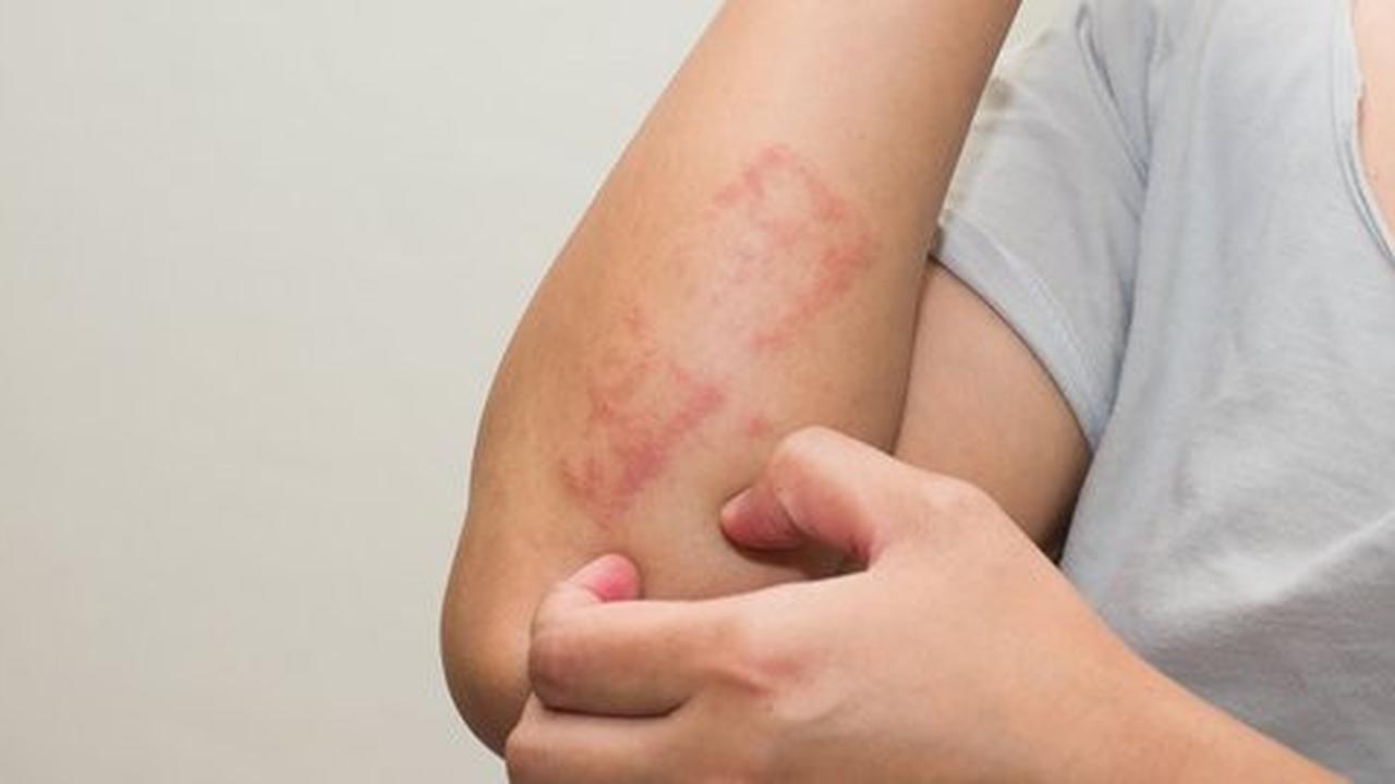 Dermatitis Kontak