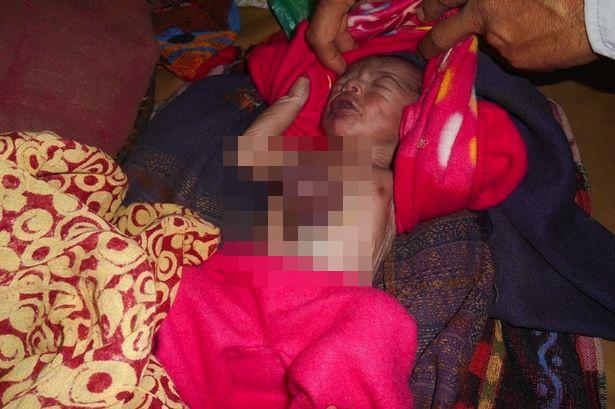 Bayi ini terus berjuang untuk hidup di hari ke-6. 90% bayi yang mengidap kelainan ini beresiko meninggal di hari ketiga | Photo copyright mirror.co.uk