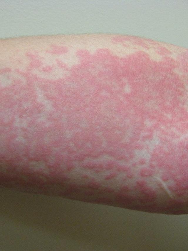 jenis alergi kulit dan gambarnya