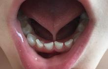 Kenali Apa Itu Tongue Tie dan Ketahui Dampaknya Terhadap Anak