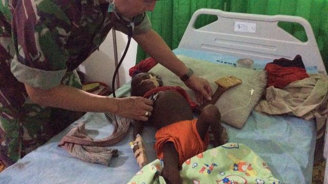 7.230 Anak Asmat Terindikasi Wabah Campak dan Gizi Buruk