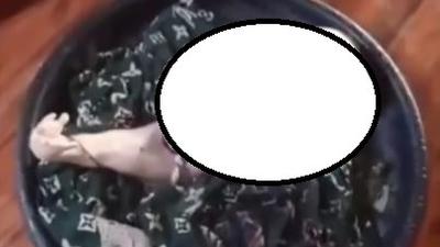 Viral Bayi dengan Kaki Menyatu di Sumatera Selatan, Begini Penjelasannya