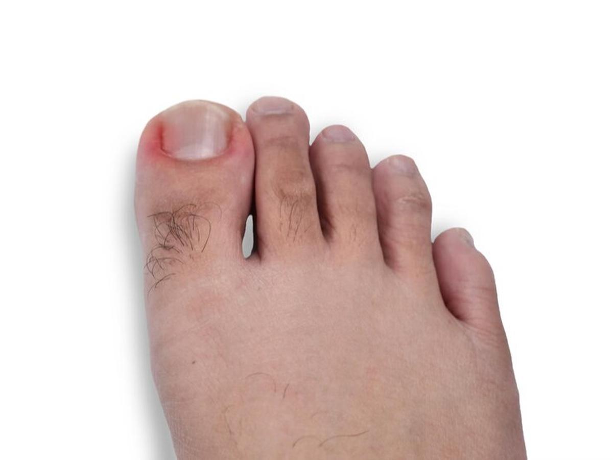Penyebab Kuku Kaki Tumbuh ke Dalam