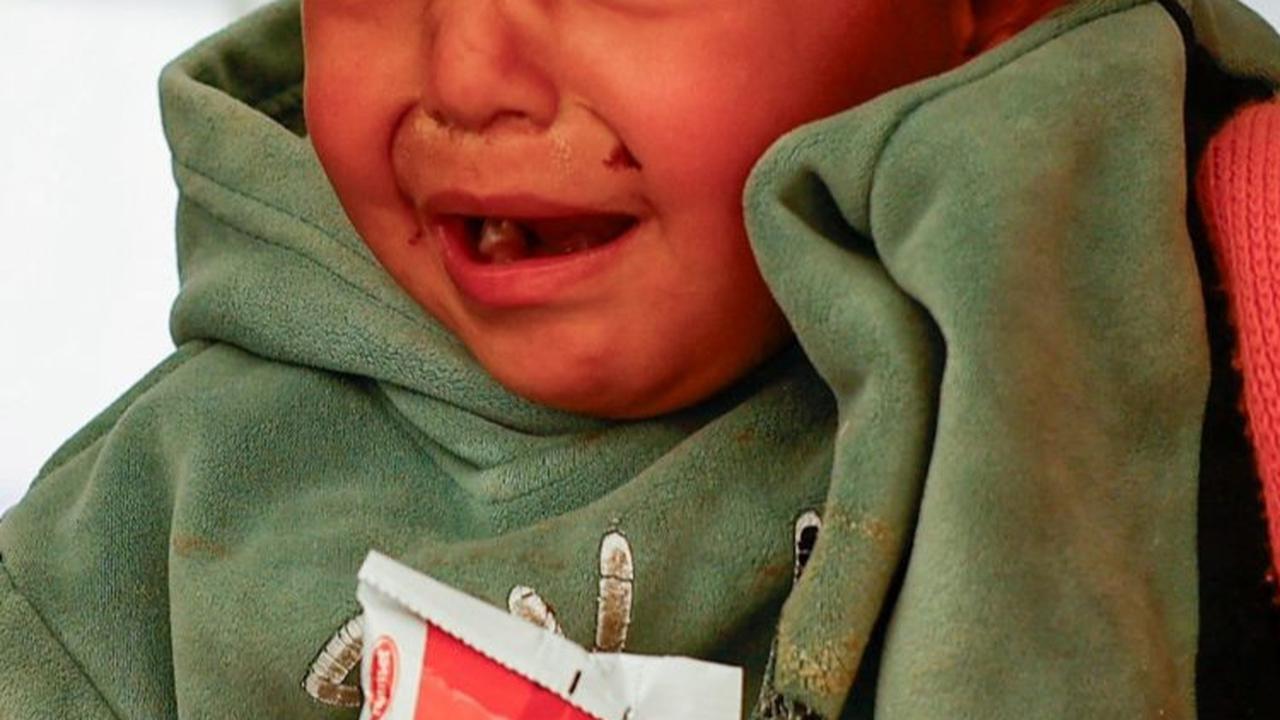 FOTO: Potret Anak-Anak Palestina Menderita Kekurangan Gizi di Pengungsian Rafah, Gaza Selatan