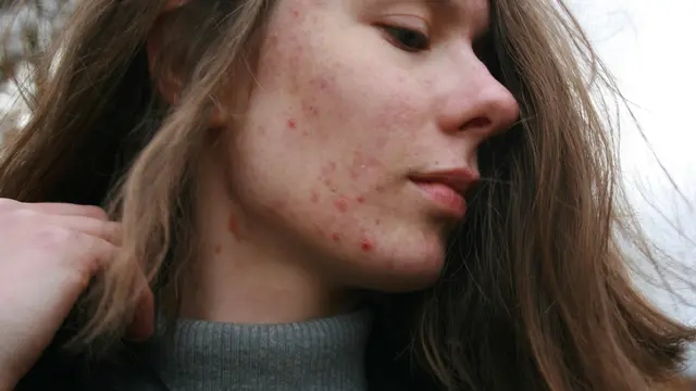 Cara Mengatasi Kulit Berminyak dengan Kandungan Skincare yang Tepat