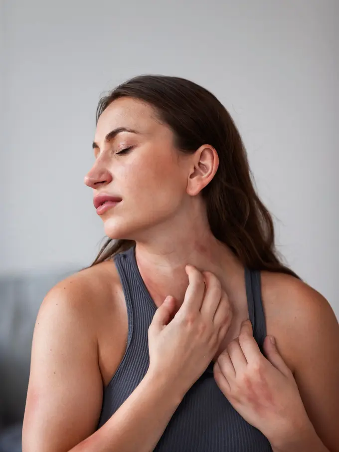 Pertolongan Pertama Kulit Terbakar Matahari: Redakan Perih dan Cegah Iritasi Lebih Lanjut