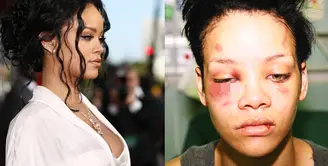 Rihanna menjadi korban kekerasan fisik yang dilakukan oleh mantan kekasihnya Chris Brown. Foto-foto Rihanna dengan wajah memar dan bengkak pun tersebar di internet. (Destination Femme)
