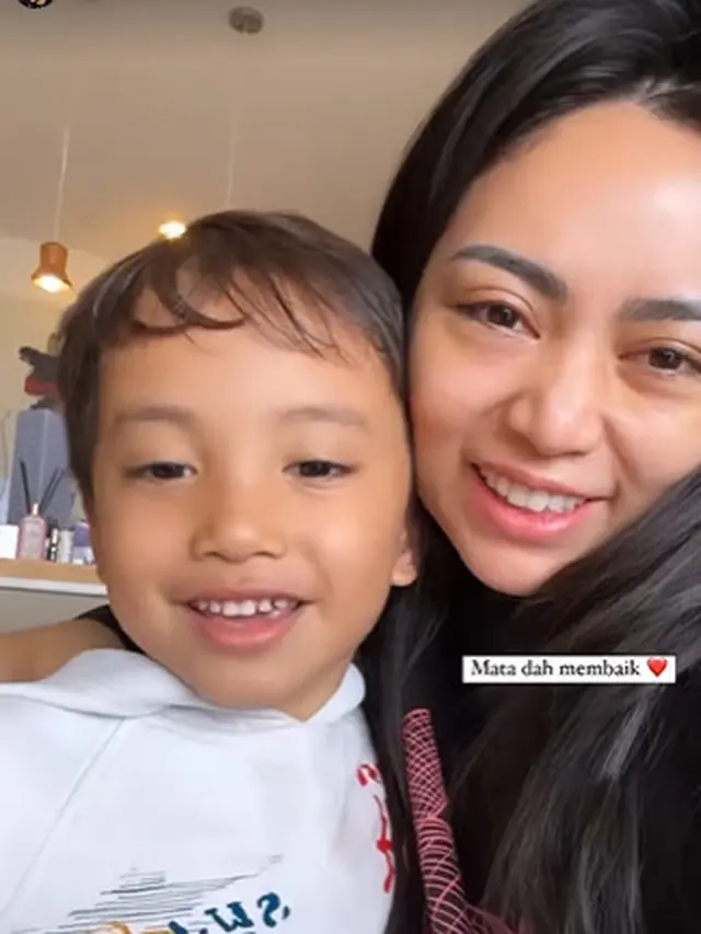 Rachel Vennya Sedot Lemak Pipi