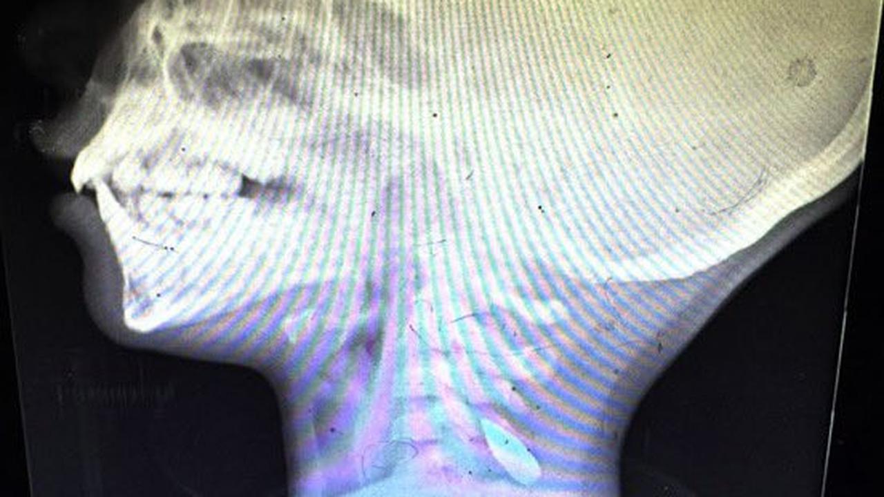 Hasil scan X-ray anak-anak di Gaza yang ditembak sniper Israel.