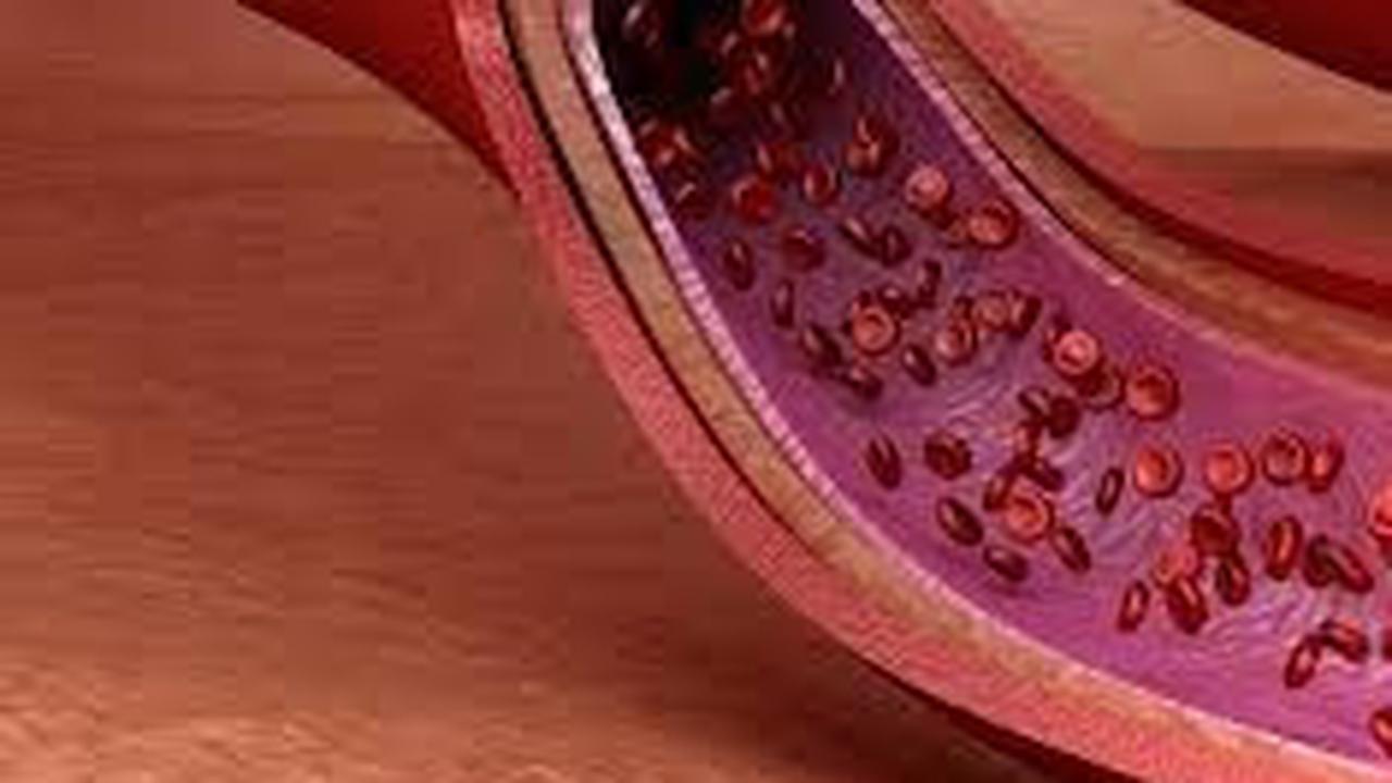 Gangguan Umum pada Arteri<br>