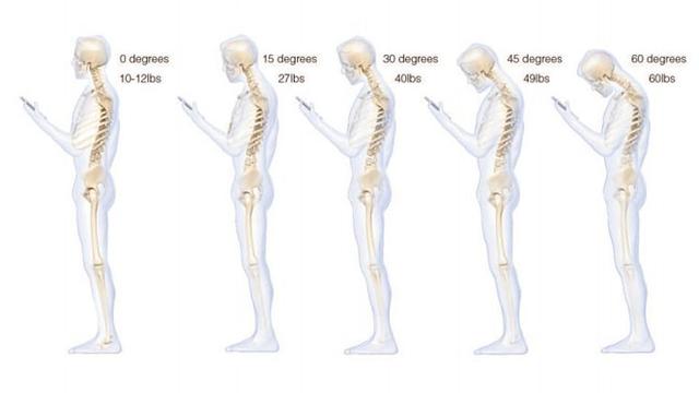 Ilustrasi sakit tulang leher