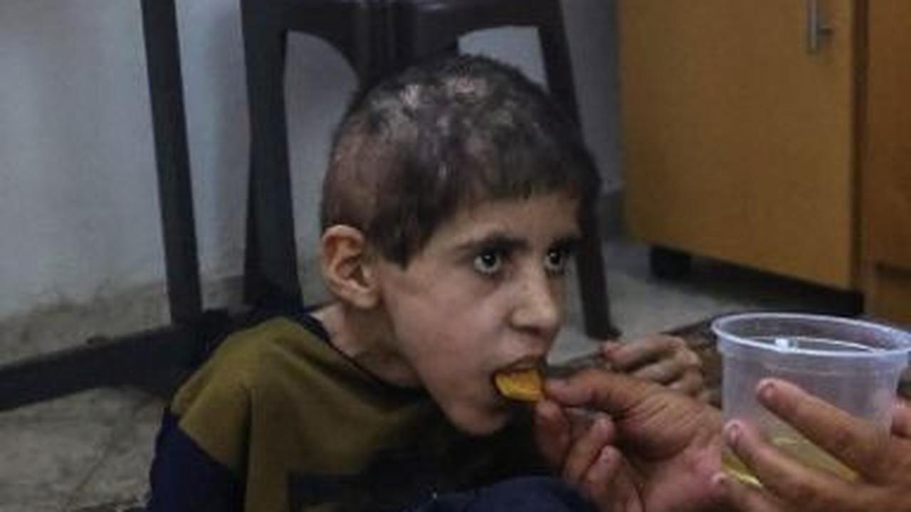 Kondisi itu menyebabkan ribuan anak-anak di Jalur Gaza menderita kekurangan gizi. Termasuk, Bahaa al-Nimr yang mengidap kelumpuhan otak atau cerebral palsy.&nbsp;(Omar Al-Qattaa/AFP)