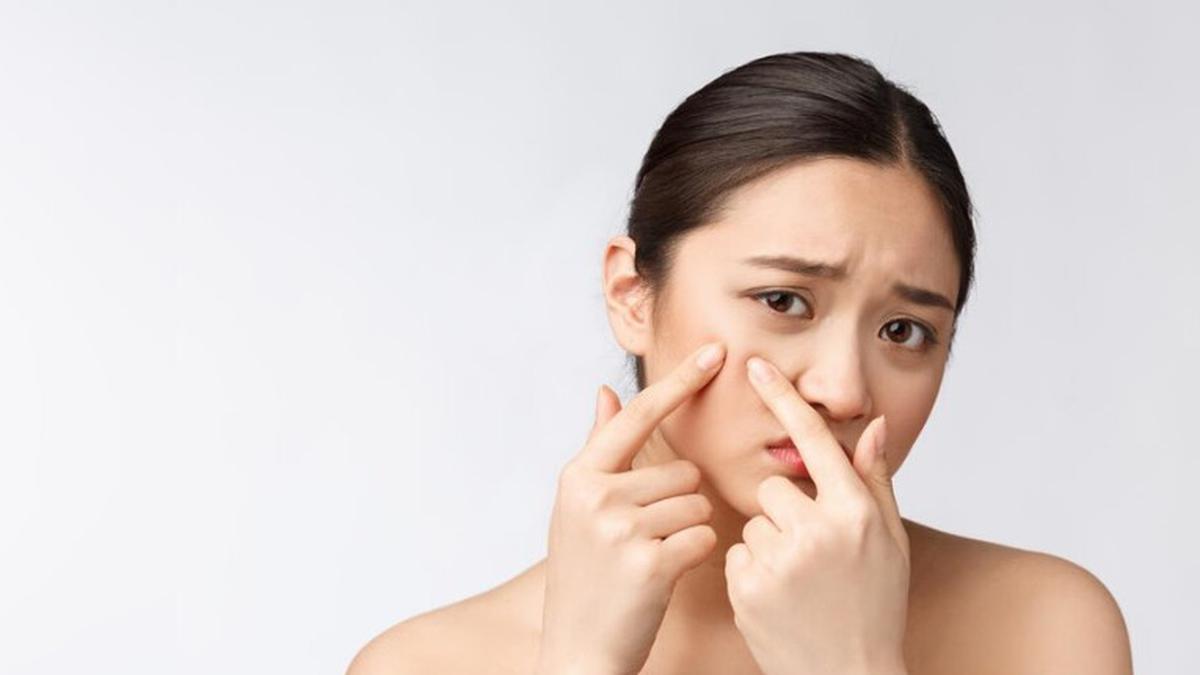 7 Trik Ampuh Cara Atasi Komedo Putih yang Wajib Sahabat Fimela Tahu!