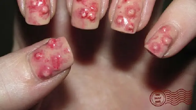Usai Kue, Kini Nail Art Jerawat yang Bisa Dipecahkan Viral