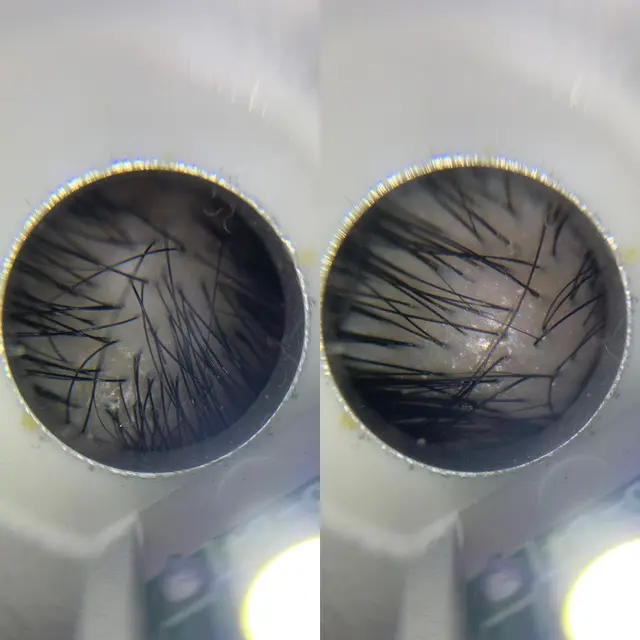 Solusi Terbaik Atasi Ketombe yang Membandel dengan Intensive Scalp Treatment