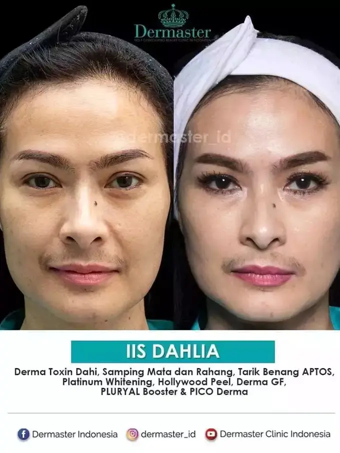 Potret Iis Dahlia sebelum dan sesudah tanam benang (Sumber: Instagram/dermaster_id)