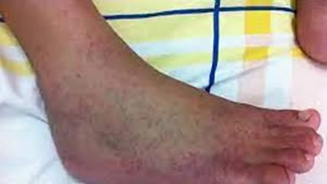 IIustrasi penyakit cikungunya ada pembekanan dan ruam pada kaki (Istimewa)