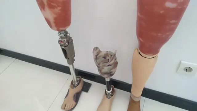 Kisah Yubita Hida, Mahasiswi Disabilitas di Yogyakarta yang Akhirnya Punya Kaki Palsu dengan Desain Lebih Humanis.