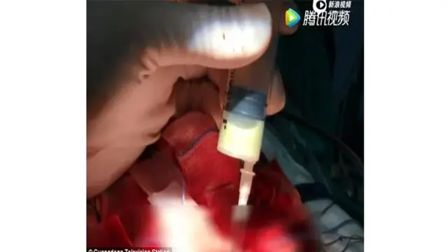 [Bintang] Gara-gara Kebiasaan Pencet Komedo, Gadis Ini Jalani Operasi Otak