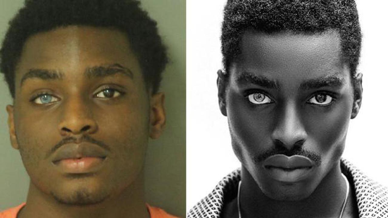 Mekhi Alante Lucky mengalami heterochromia