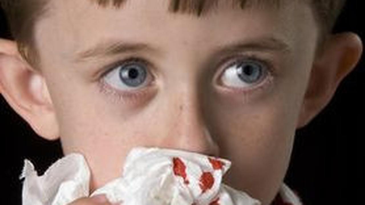 Dengan melakukan langkah-langkah sederhana dan pencegahan yang tepat, mimisan dapat dihindari dan kondisi kesehatan hidung dapat tetap terjaga.