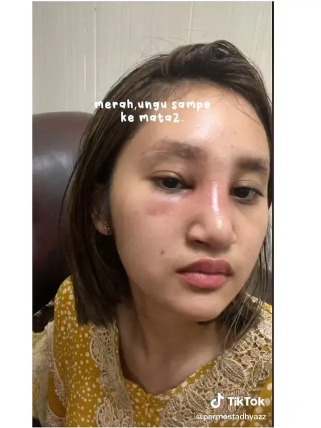 6 Potret Kronologi Dhyaz Anak Farida Nurhan Alami Infeksi Hidung Pasca Implan