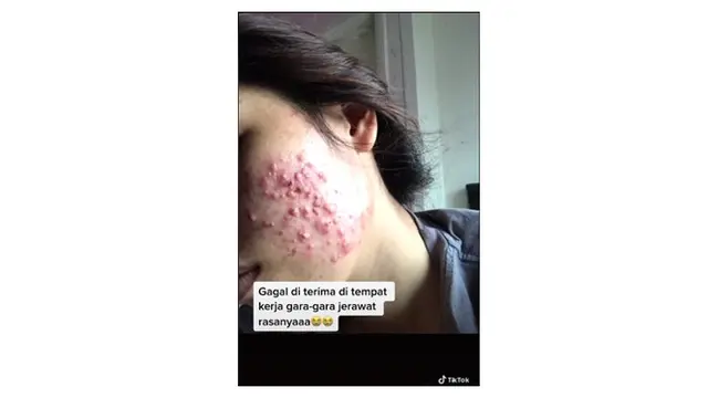 Sudah Lolos Psikotes, Wanita Ini Gagal Diterima Kerja Gara-gara Jerawat