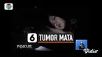 Thumbnail Tumor Mata