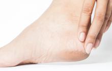 Cara Aman Atasi Kulit Kaki Mengelupas, Hindari Langkah Berbahaya Ini yang Bikin Kaki Infeksi