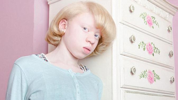 Potret Cantik Model Albino Bidikan Mahasiswi Tingkat Akhir - Health