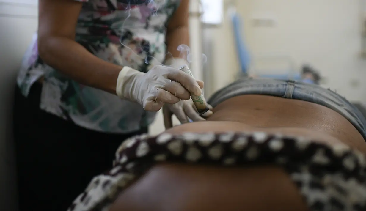 Seorang dokter melakukan terapi moksibusi, sejenis pengobatan tradisional Tiongkok, pada pasien terpapar virus Corona COVID-19 yang baru pulih di pusat kesehatan yang dikelola pemerintah di lingkungan Coche di Caracas, Venezuela pada 25 Februari 2021. (AP Photo / Matias Delacroix)