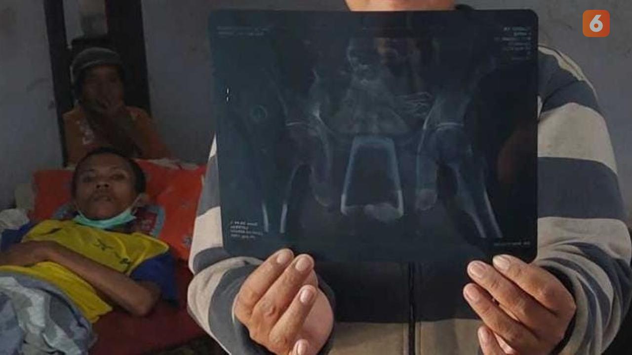 Gelas dalam tubuh warga Jember (Liputan6.com/Istimewa)