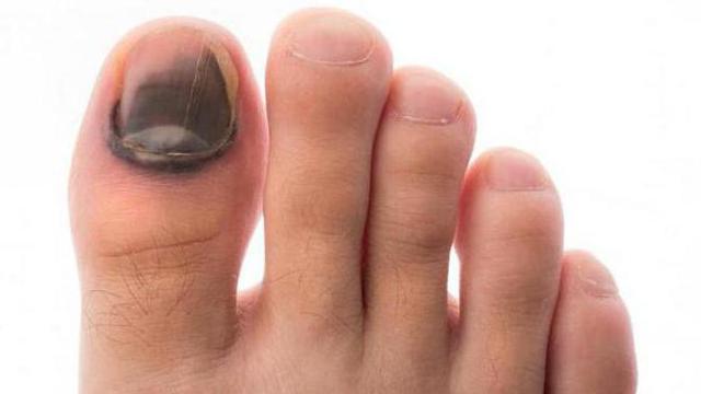 5 Warna Pada Kuku Kaki Ternyata Bisa Ungkap Kesehatanmu