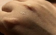 6 Cara Ampuh Menghilangkan Keloid yang Membandel dan Mengembalikan Percaya Diri Anda