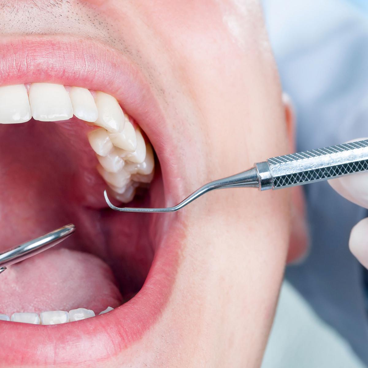 Cara mencegah gigi berlubang agar tidak membesar