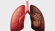 Kanker Paru-paru - KlikDokter.com (BlueRingMedia/Shutterstock)