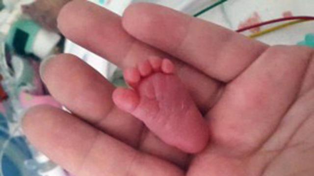 Bayi Terkecil Sedunia Lahir Dengan Berat 8 Ons Health Liputan6 Com