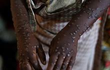 Pembesaran Kelenjar Getah Bening Jadi Ciri Khas Bedakan Mpox dengan Penyakit Lainnya