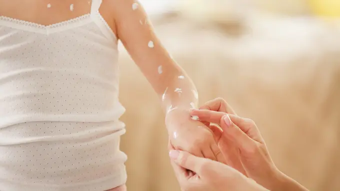 5 Cara Efektif Hilangkan Bekas Luka Cacar Air (Africa Studio/shutterstock)