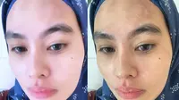 Kartika Putri Ungkap Wajah Tanpa Dipercantik Filter, Tak Segan Tampilkan Efek Stevens-Johnson Syndrome