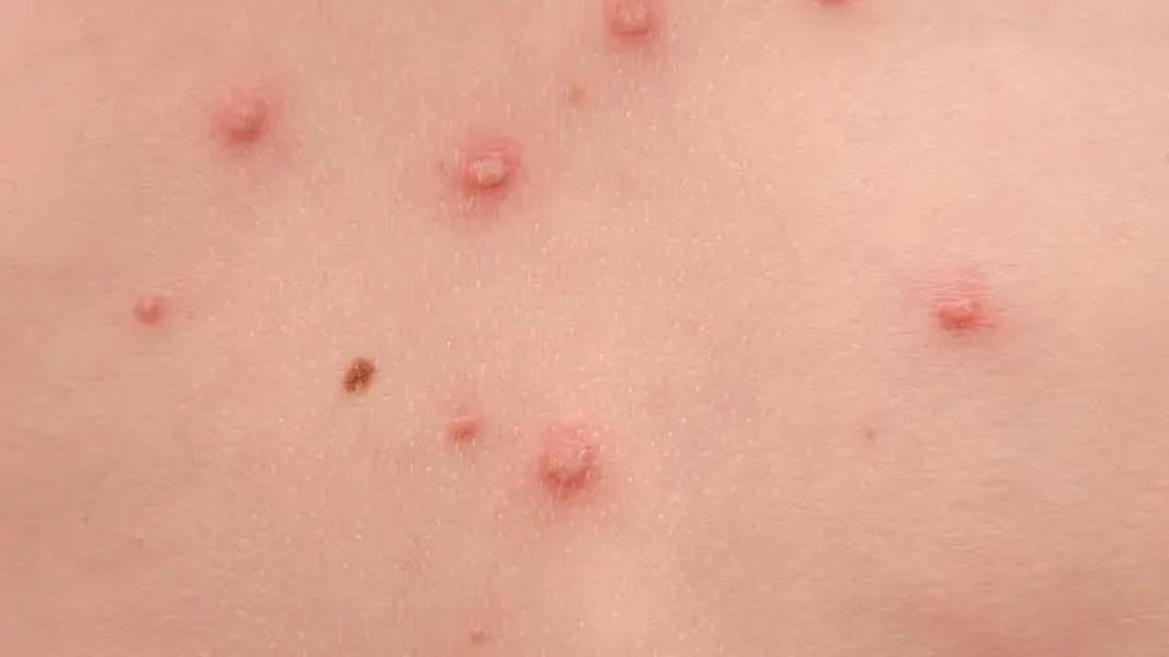 Waspada Cacar Air: Ciri-Ciri pada Anak dan Orang Dewasa yang Perlu Diketahui Sejak Dini