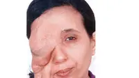 Tumor Wajah Nyaris Renggut Seluruh Kebahagiaan Wanita Ini