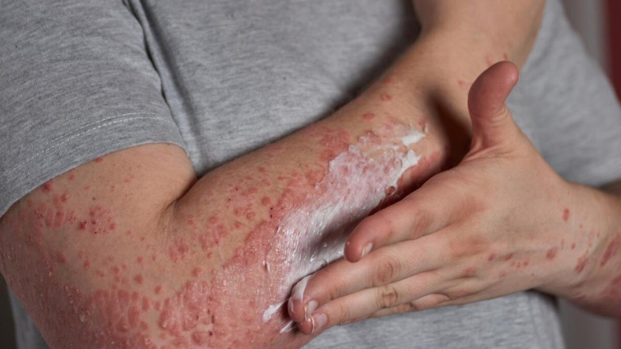 Steven Johnson Syndrome: Panduan untuk Pasien dan Keluarga dalam Proses Diagnosa
