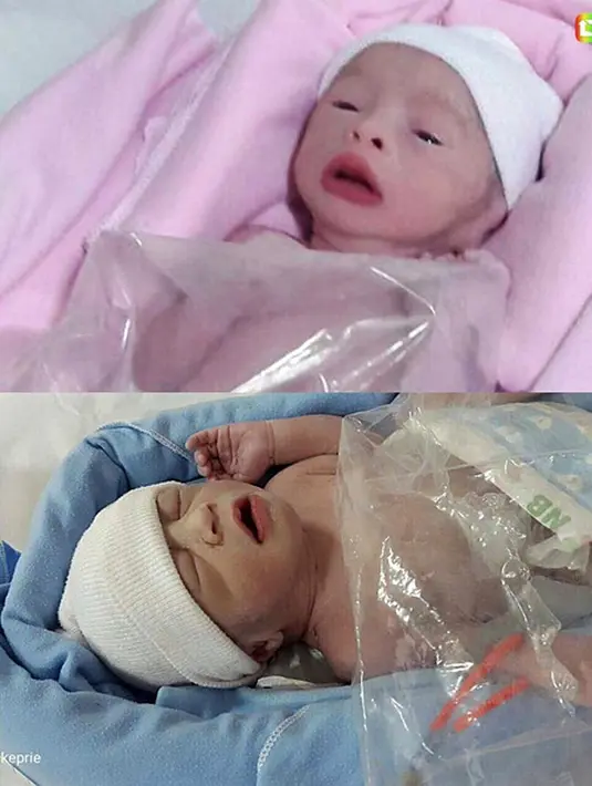Berdasarkan penuturan dokter yang menanggani, yang keluar duluan adalah berjenis kelamin perempuan. Baru setelah itu bayi mungil laki. Seperti bayi kebanyakan, setelah terlahir didunia langsung nangis. (Instagram/suryasaputra)
