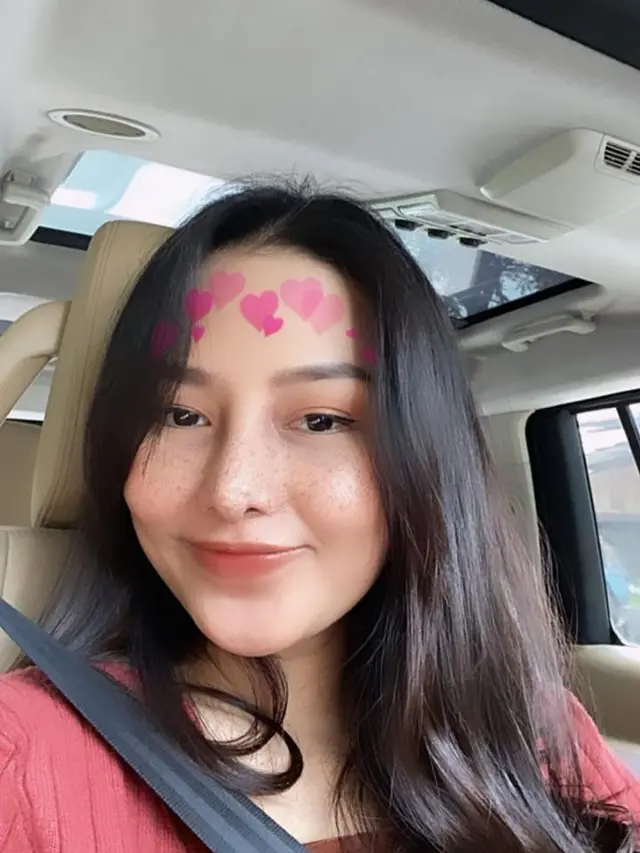 Potret Terbaru Dara Arafah setelah Operasi Rhinoplasty