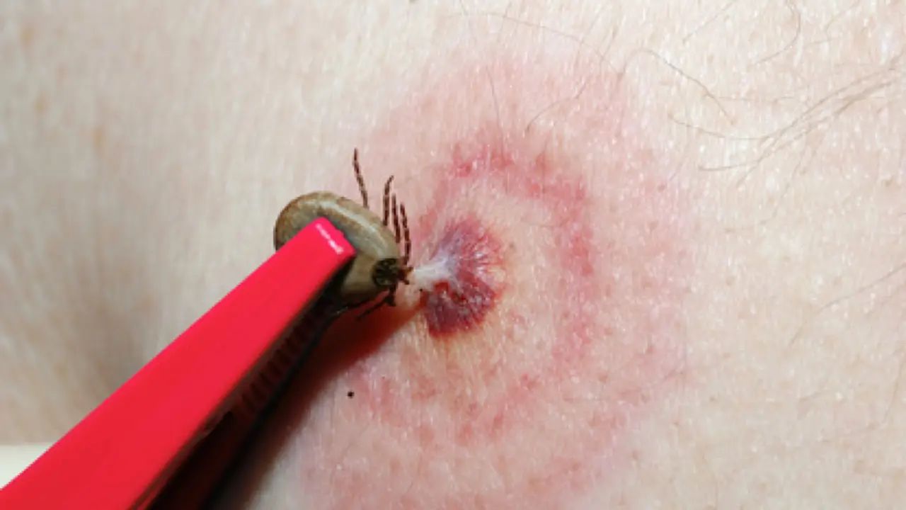 Lyme Disease