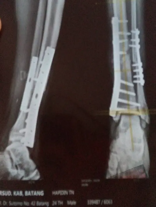 Hasil rontgen yang memperlihatkan kondisi kaki Hapidin. Kini Hapidin tengah menjalani pengobatan cuma-cuma dari seorang fisioterapis, Asep Aziz. (Instagram/hapidin_7)